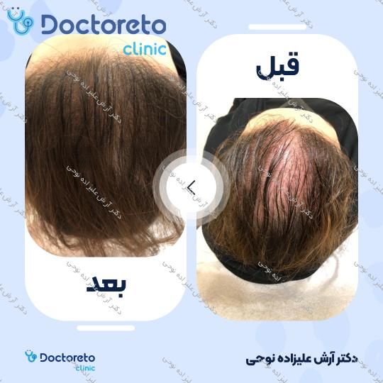 تزریق مزوتراپی مو جهت قطع ریزش مو