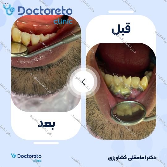 جرم گیری دندان با بروساژ🦷