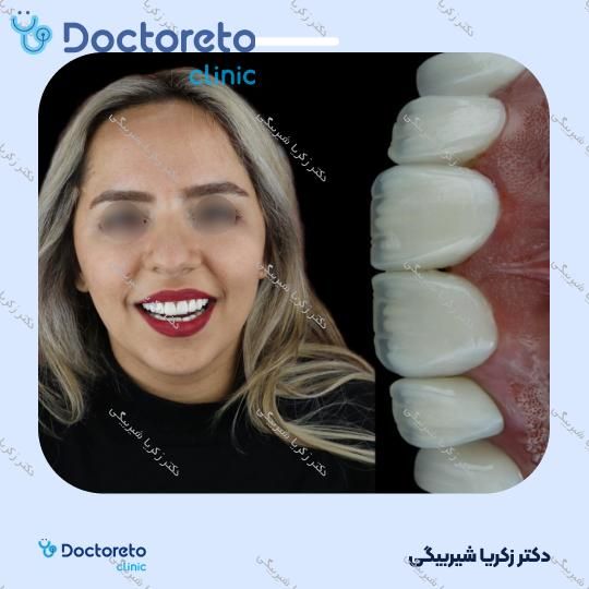 لمینت دندان (هر واحد)