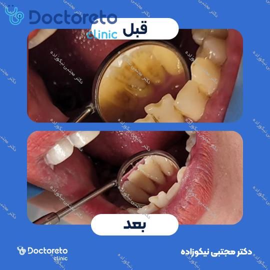 جرم گیری دندان با بروساژ🦷