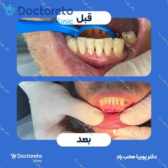 جرم گیری دندان با بروساژ🦷