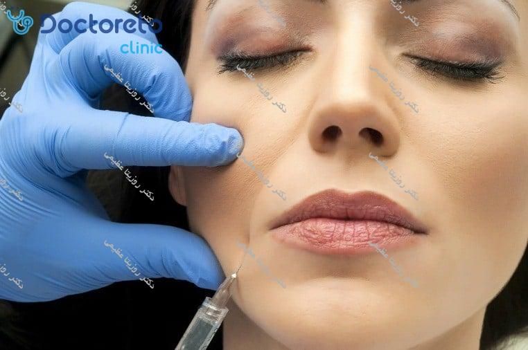 تزریق ژل خط لبخند با برند لوناژل (1CC)