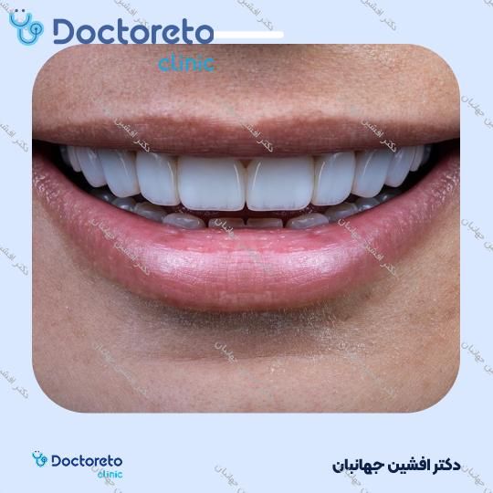 جرم گیری دندان با بروساژ