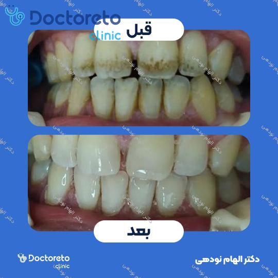 جرم گیری دندان با بروساژ🦷