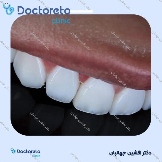 روکش دندان (هر واحد)