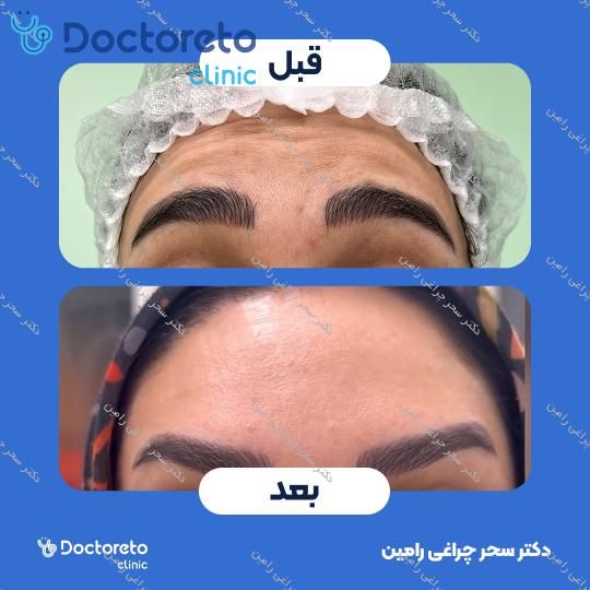 تزریق بوتاکس صورت