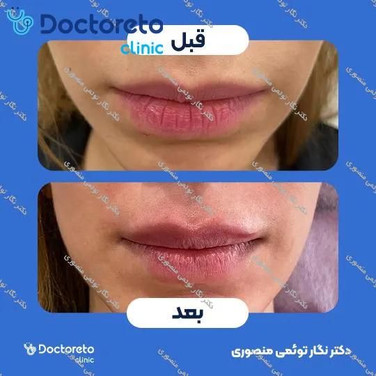 تزریق ژل لب