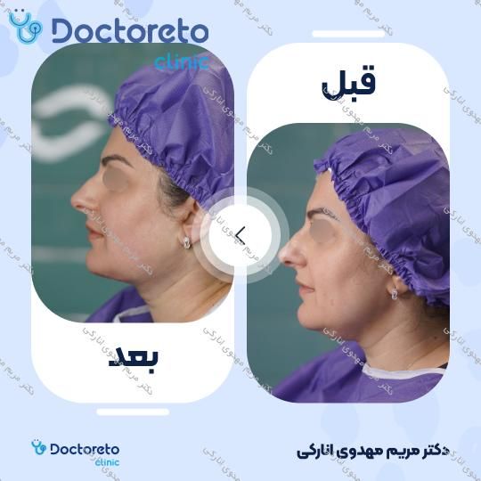 رفع غبغب به روش ساکشن