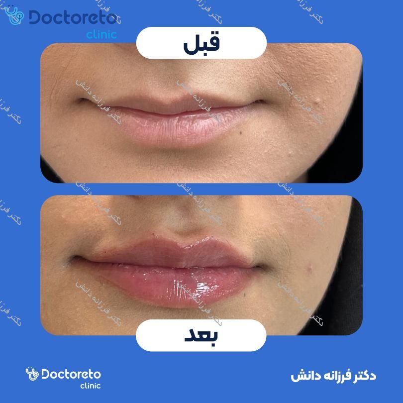 تزریق ژل لب