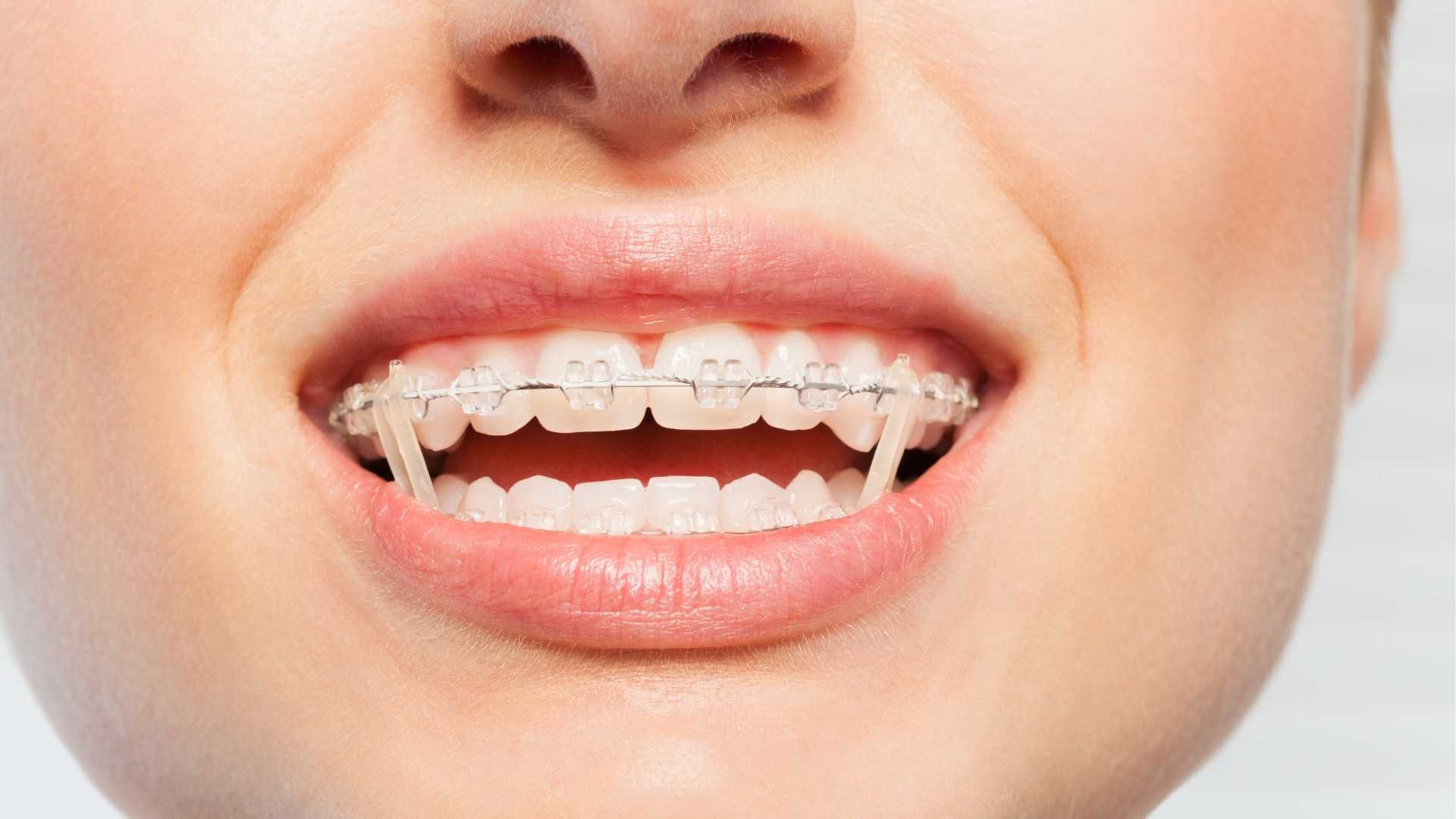 ارتودنسی متحرک نامرئی (2فک)