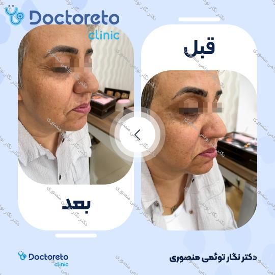 هایفوتراپی صورت، گردن و غبغب با دستگاه اولترا (1 جلسه)