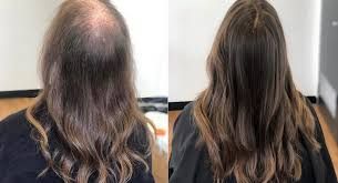 آزمایش ریزش مو در زنان