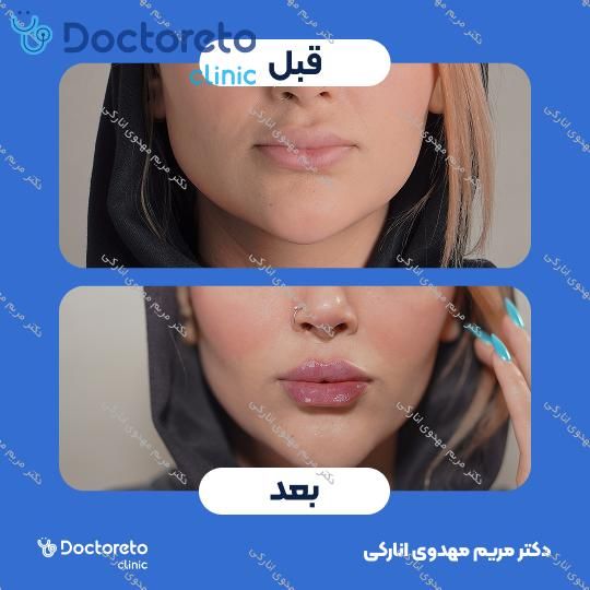 تزریق ژل لب