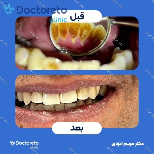 جرم گیری دندان با بروساژ 🦷