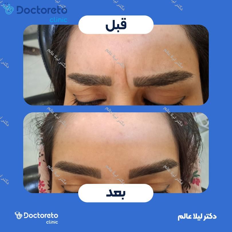 تزریق بوتاکس صورت 💉