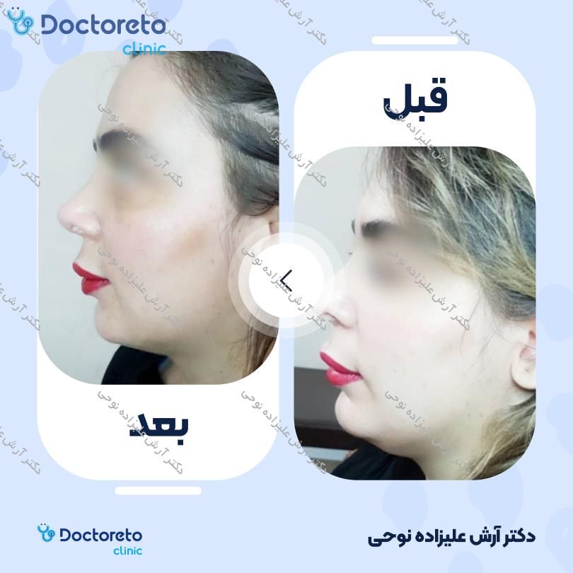 تزریق مزوتراپی برای رفع غبغب