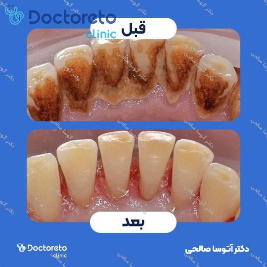 جرم گیری دندان با بروساژ🦷