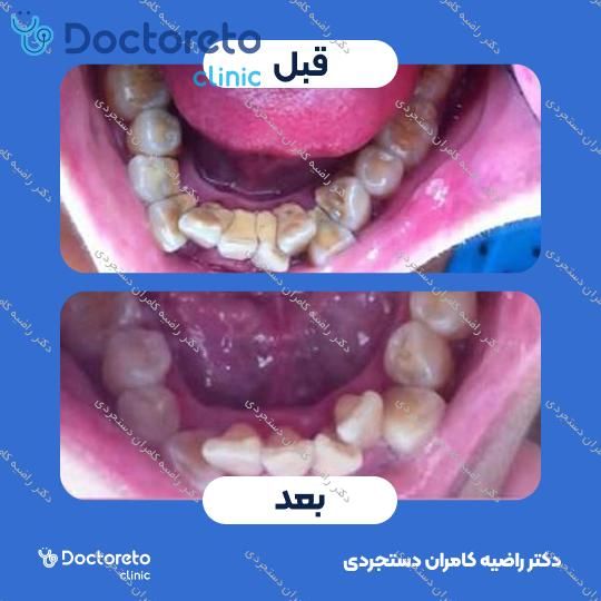 جرم گیری دندان با بروساژ🦷