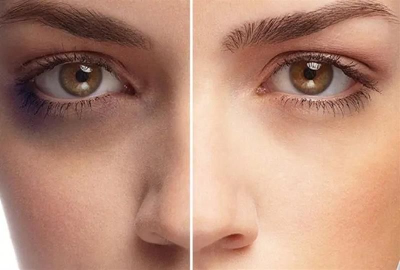 تزریق مزوتراپی برای رفع پف و سیاهی زیرچشم