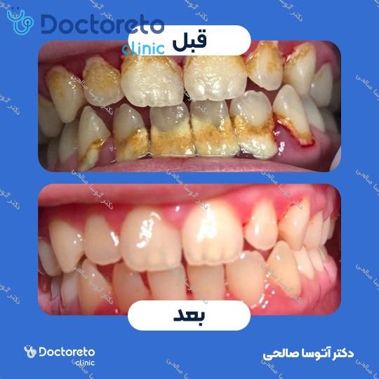 جرم گیری دندان با بروساژ🦷