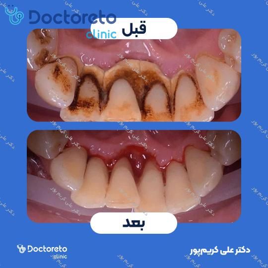 جرم گیری دندان با بروساژ🦷
