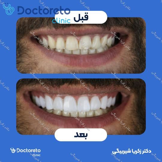 ونیر کامپوزیت (هر واحد)