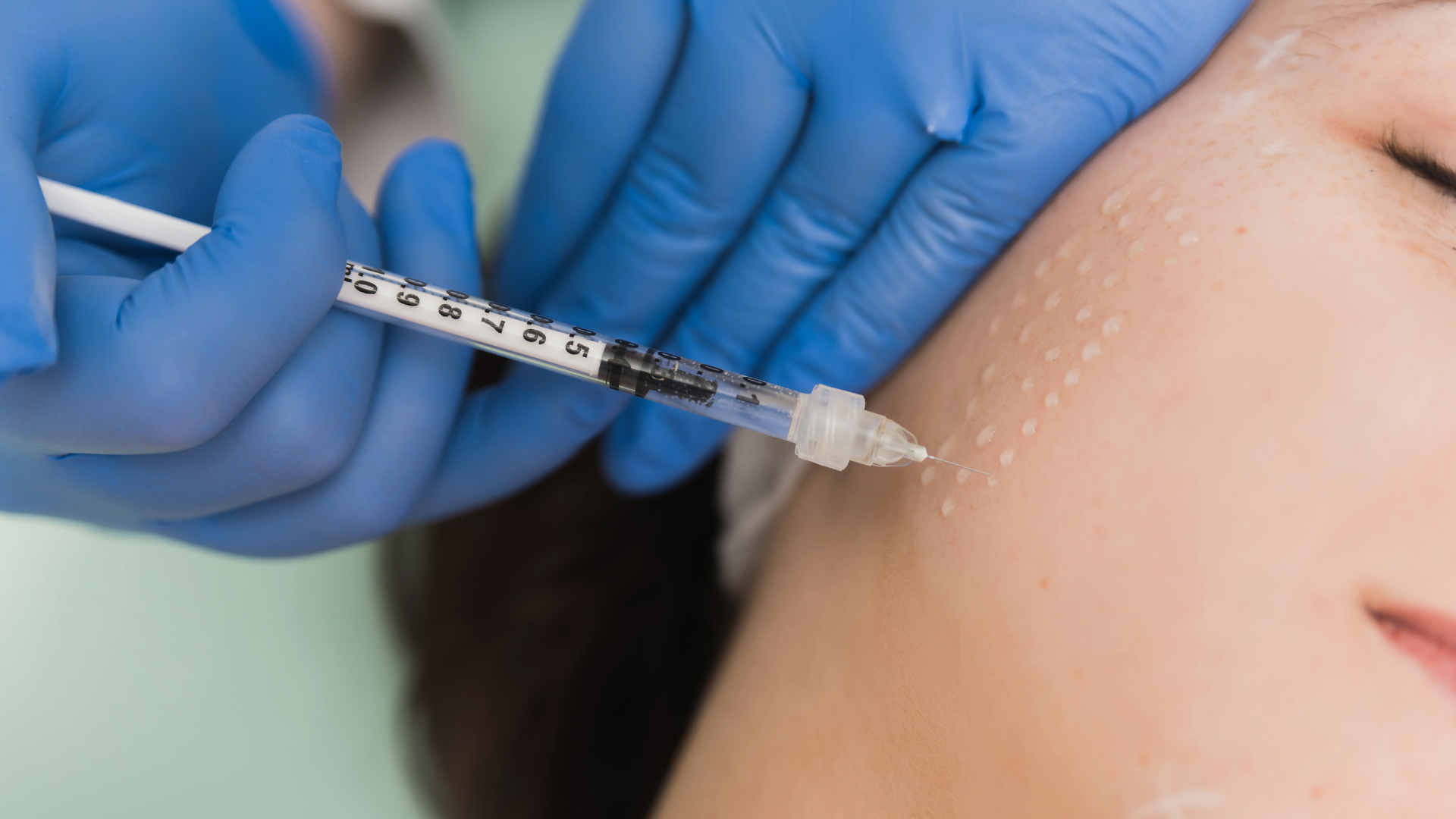 تزریق مزوتراپی برای جوانسازی و آبرسانی صورت