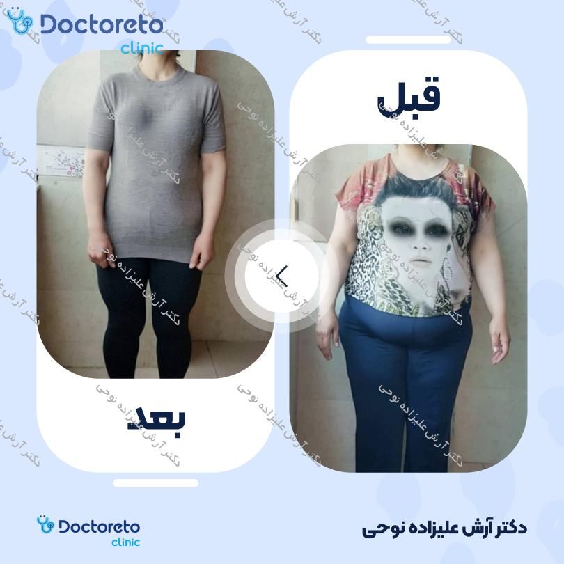 لاغری موضعی با دستگاه کویتیشن، به همراه و رژیم لاغری