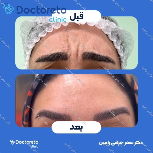 تزریق بوتاکس صورت