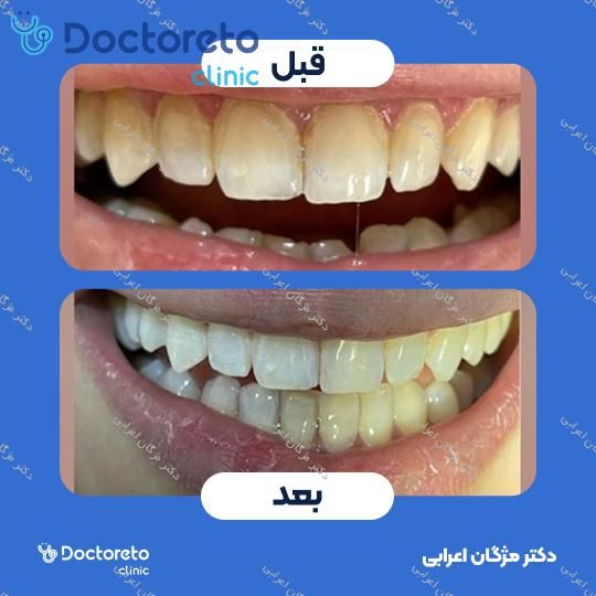 جرم گیری دندان با بروساژ🦷