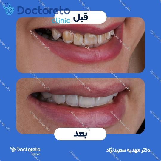 لمینت سرامیکی ایمکس آلمانی (هر واحد)