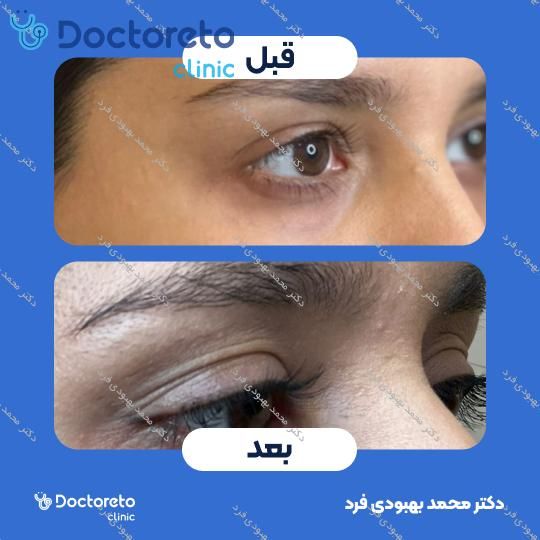 تزریق بوتاکس صورت 💉