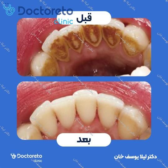 جرم گیری دندان با بروساژ🦷