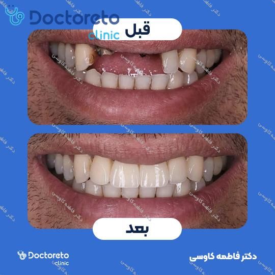 جراحی پیوند استخوان (هر واحد)