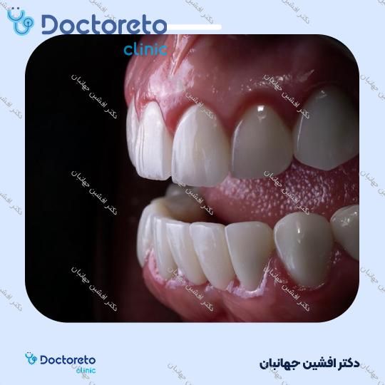 روکش دندان (هر واحد)