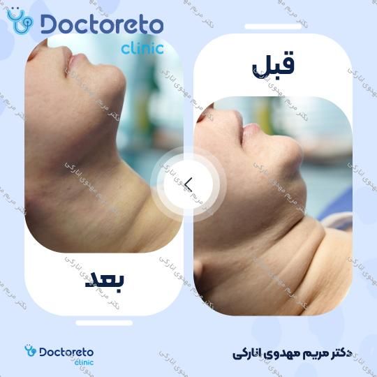 رفع غبغب به روش ساکشن