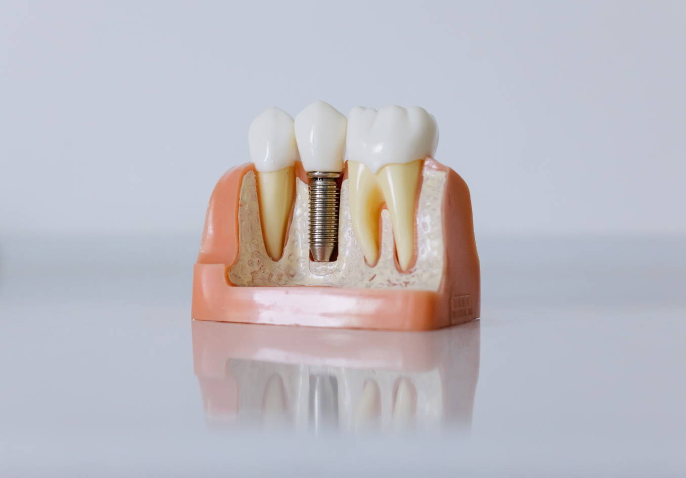 ایمپلنت دندان با روکش (هر واحد)