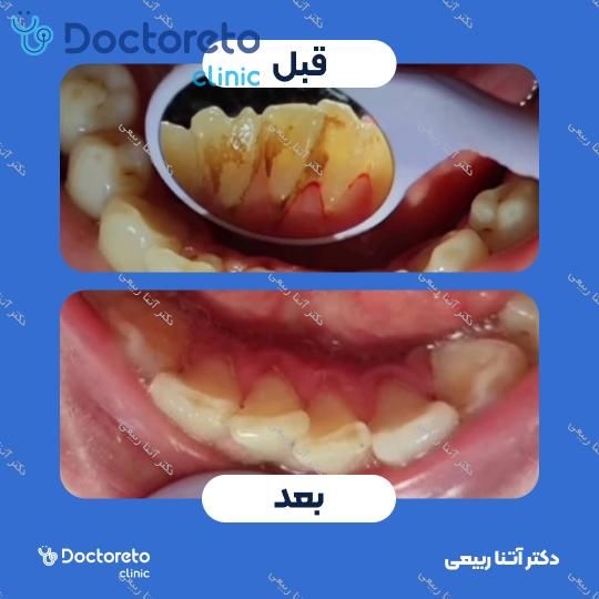 جرم گیری دندان با بروساژ🦷