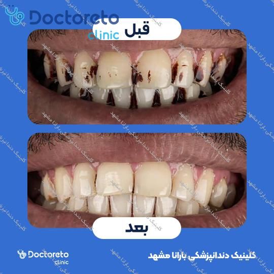 جرم گیری دندان با بروساژ🦷