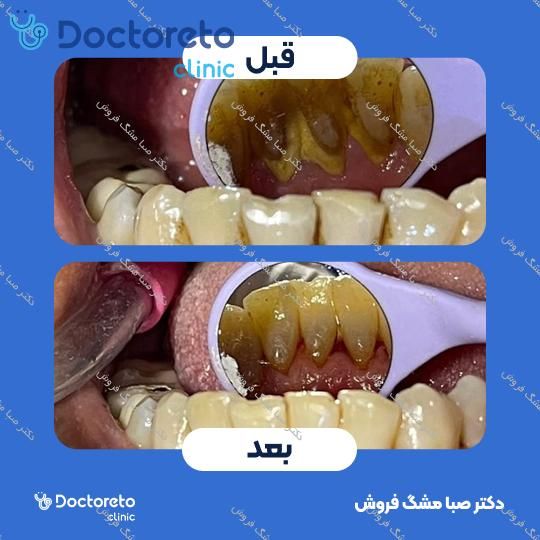جرم گیری دندان با بروساژ 🦷