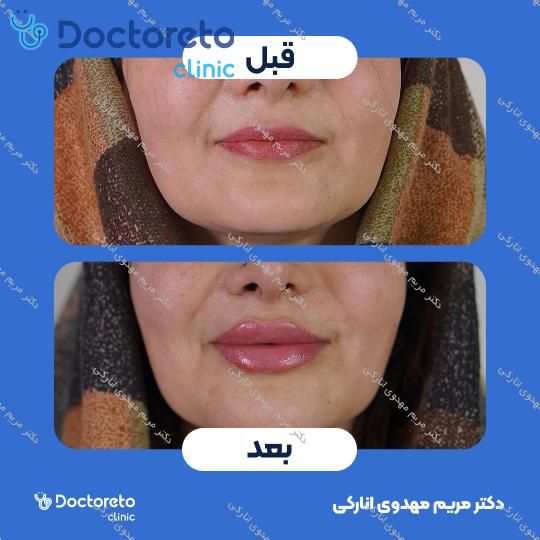 تزریق ژل لب