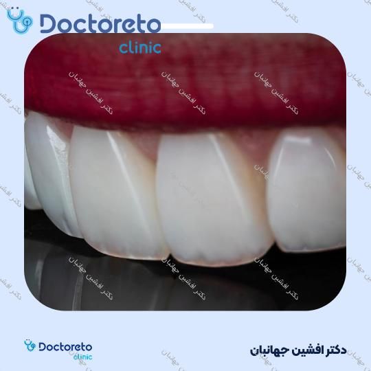روکش دندان (هر واحد)