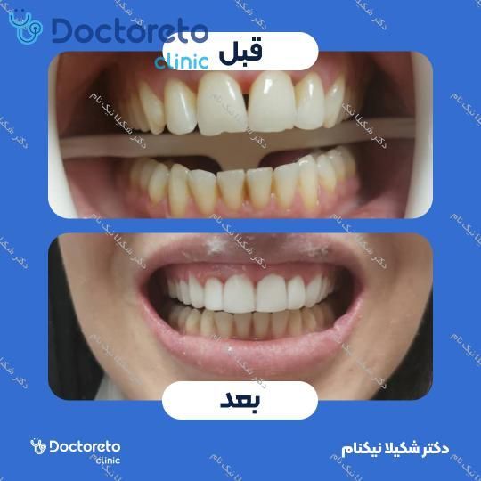 جرم گیری دندان با بروساژ 🦷