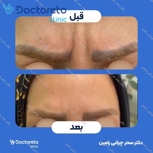 تزریق بوتاکس صورت