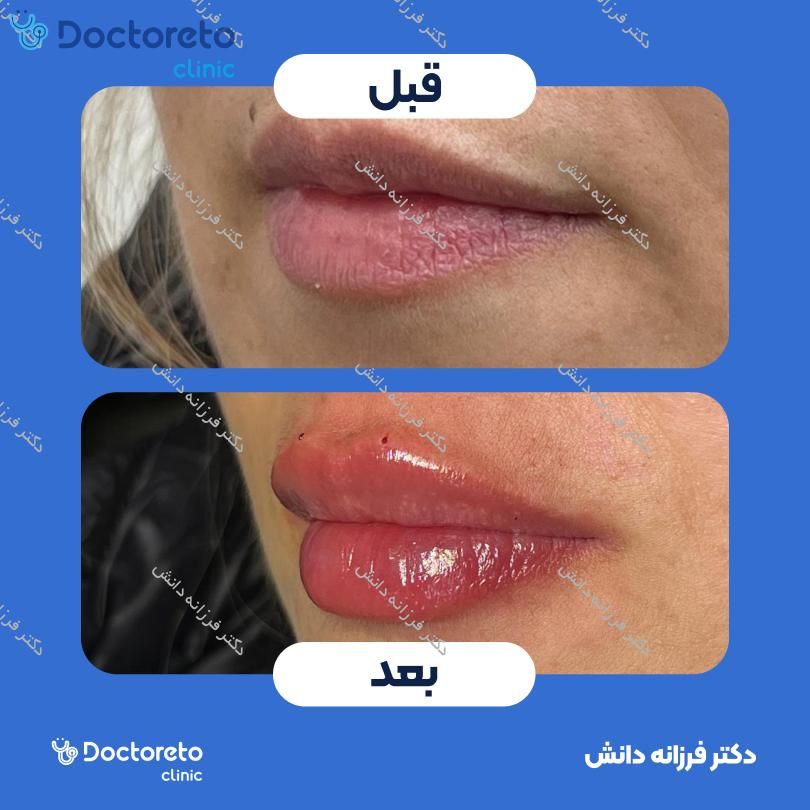 تزریق ژل لب