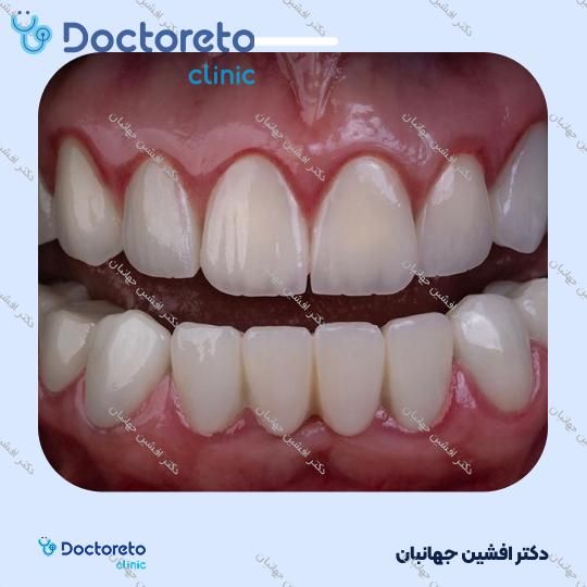 روکش دندان (هر واحد)