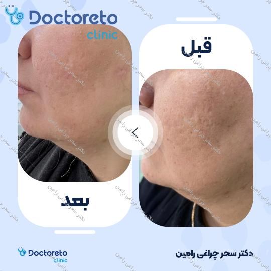 درمان جای جوش و منافذ باز پوست با دستگاه آر اف فرکشنال (هر جلسه)