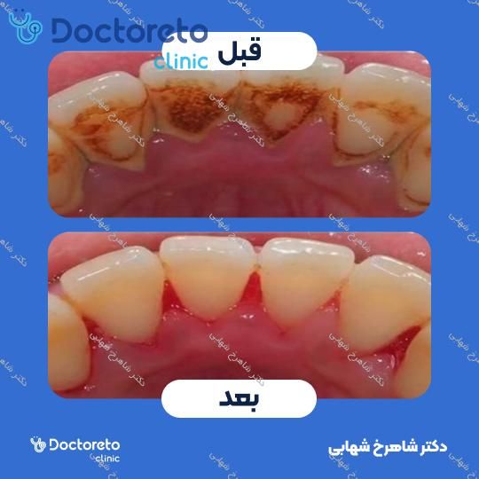 جرم گیری دندان با بروساژ🦷