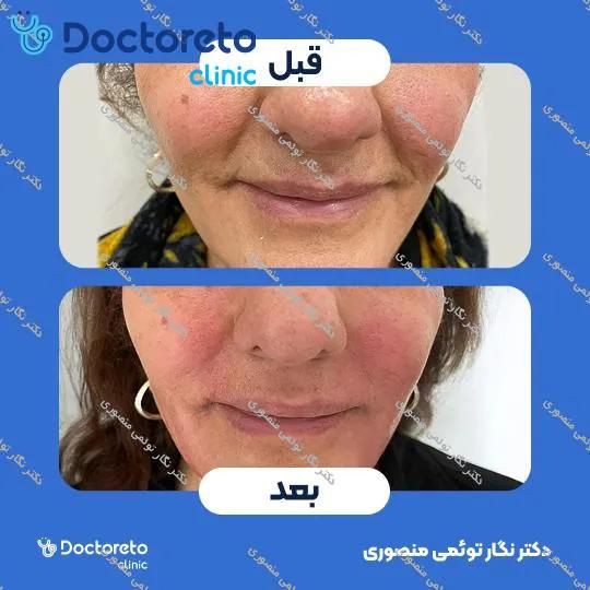 تزریق ژل خط خنده