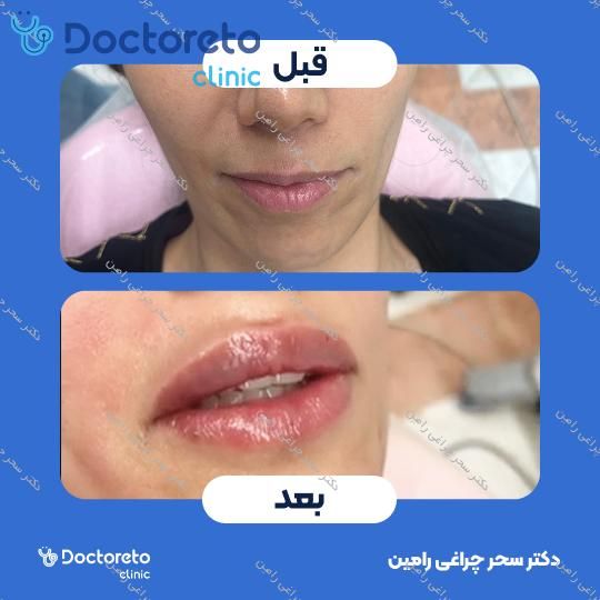 تزریق ژل لب
